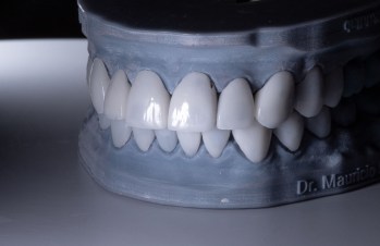 Carillas de Resina en diferentes precios