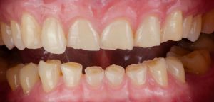 Ejemplo de daño dental por bruxismo