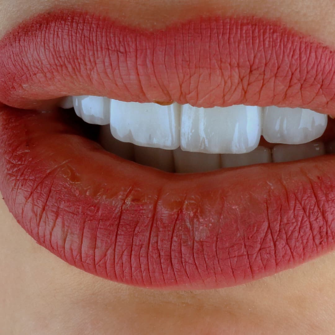 Carillas de Resina: qué son, cuidados y preguntas frecuentes