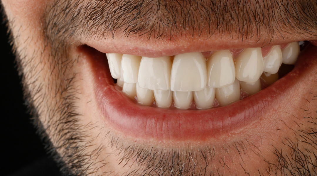 Las carillas de porcelana/cerámica en Santiago de Chile: Tu guía completa