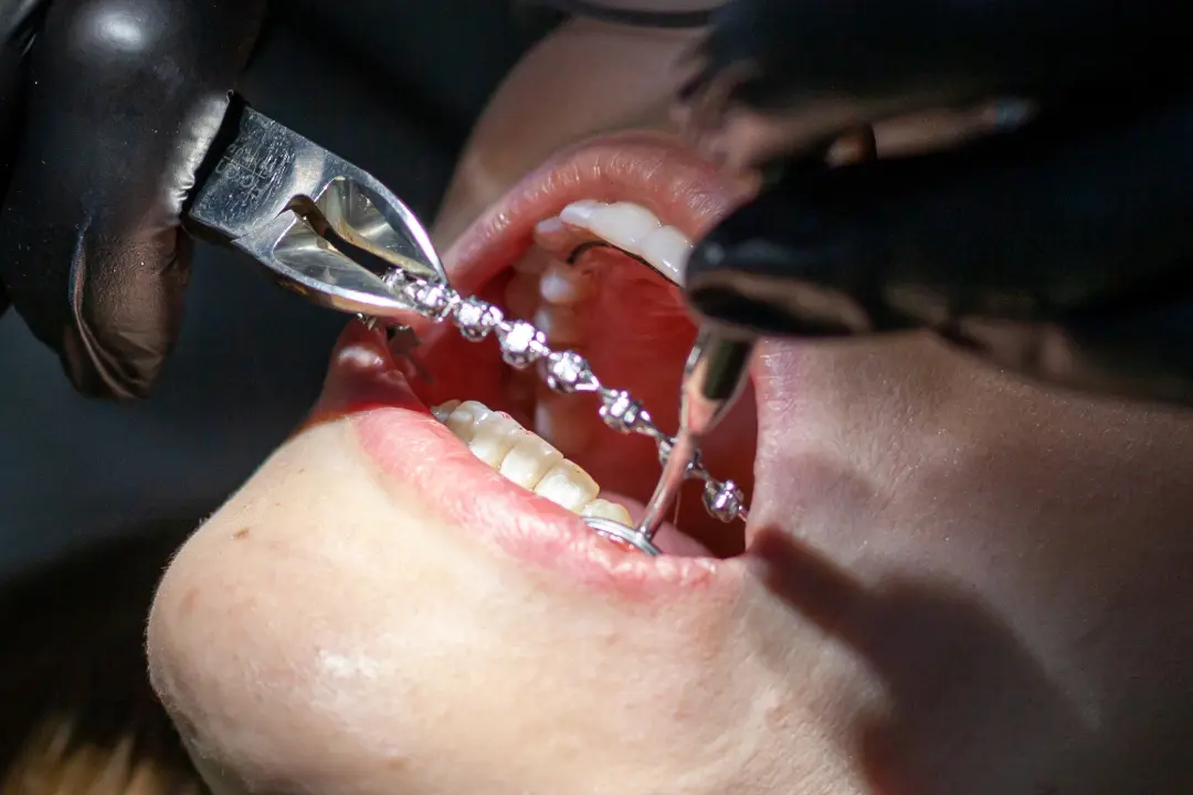 Retiro de Brackets Precio 2024 Santiago – $45.000