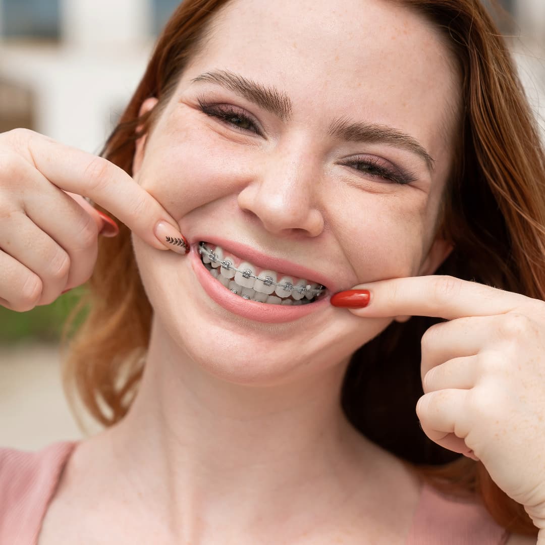 Brackets Metálicos ¿Que son?