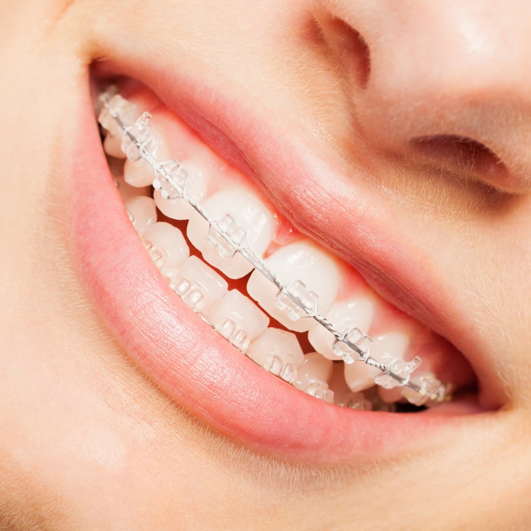 Brackets de Zafiro: Posiblemente los más hermosos brackets