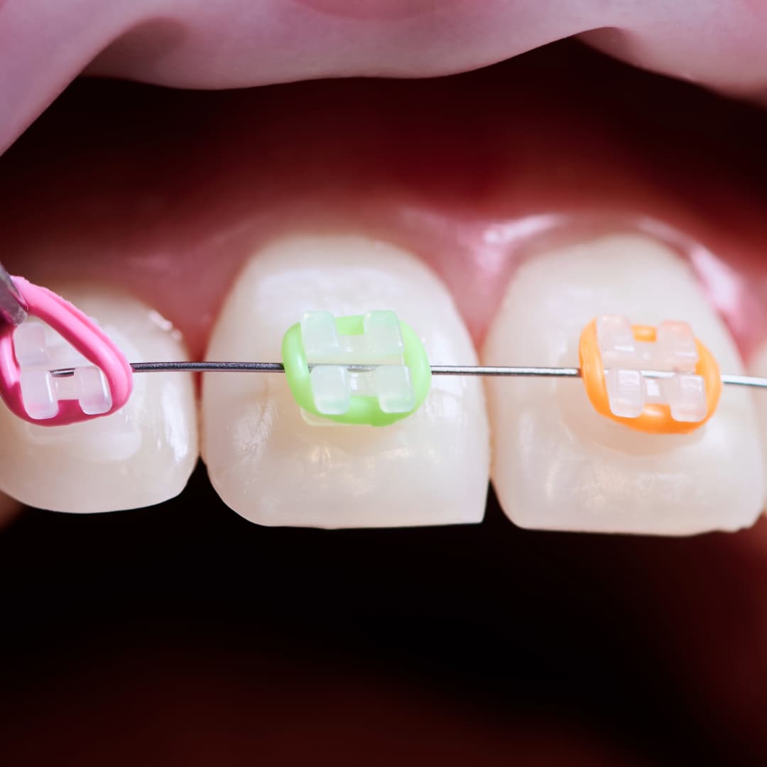 Brackets Cerámicos: Todo lo que deberías saber